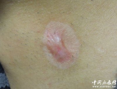 淺析放射性同位素敷貼治療方法_儀器修復(fù)_疤痕修復(fù)_中國(guó)疤痕網(wǎng) - 您身邊的疤痕修復(fù)專家